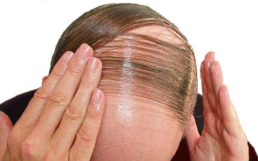 hair loss men